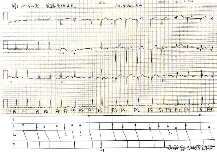 心动过速怎么治疗,多发性多源性室性心动过速