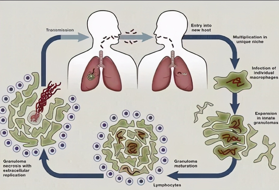 预防结核病最有效措施免疫学,干细胞治疗结核病