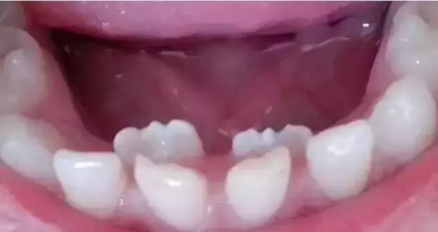 孩子长双层牙怎么回事,孩子长双层牙