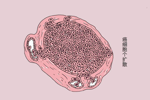 癌症转移有什么症状和表现,肺癌症晚期已转移扩散能活多久