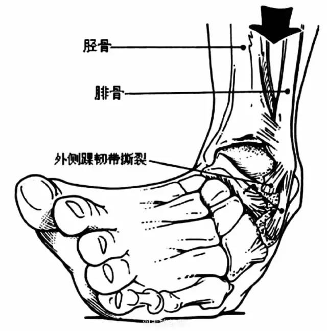 打羽毛球扭伤怎么处理,打羽毛球踝关节疼痛