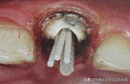 纤维桩修复费用,纤维桩修复全过程视频