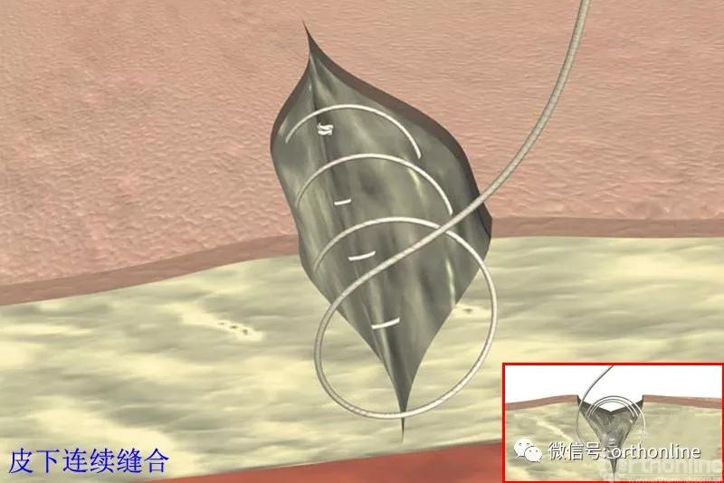 十种外科基本缝合方式详解,手术切口缝合有哪几种