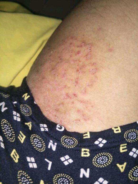 股癣皮肤病,简述体癣和股癣的预防