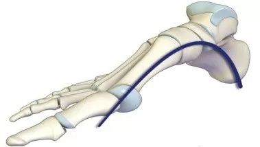 足弓不好的步态问题,如何改善足弓往里弯