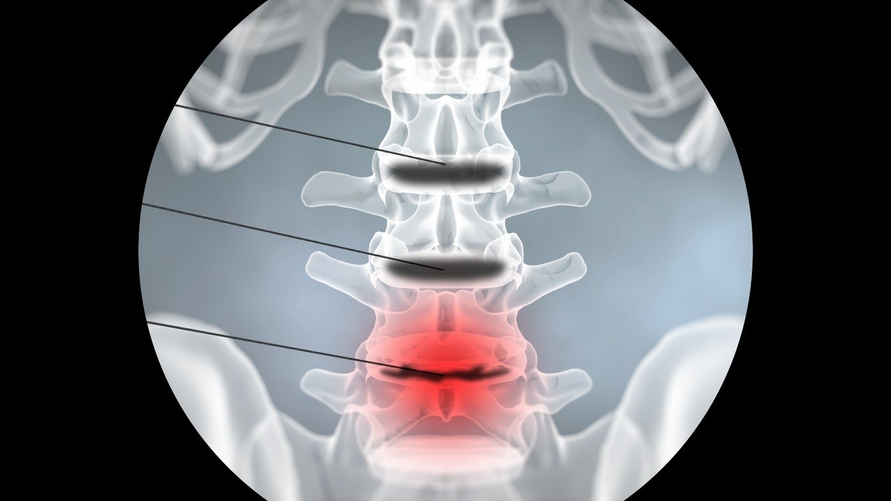 久治不愈腰痛,磁共振没有突出间盘后缘白点,要警惕这病③