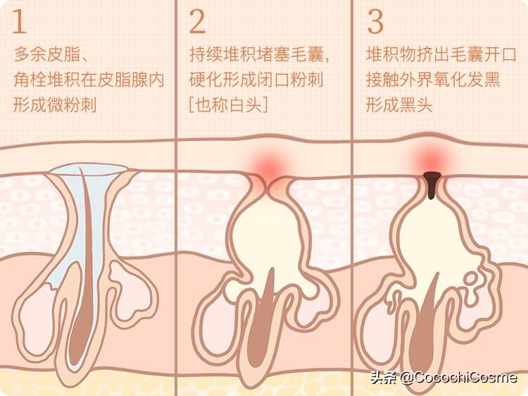 用芦荟擦黑头会去掉黑头吗,黑头铲能去除所有黑头吗