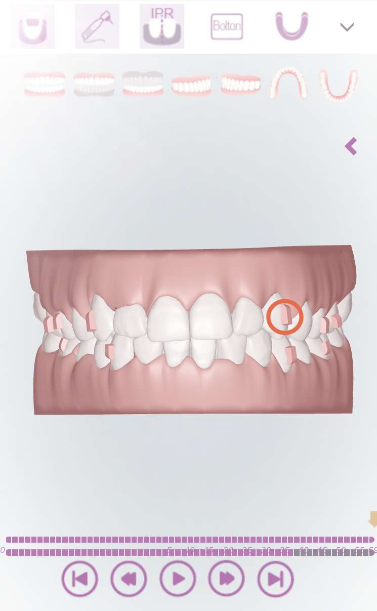 记录我的牙套日记,牙套日记日常