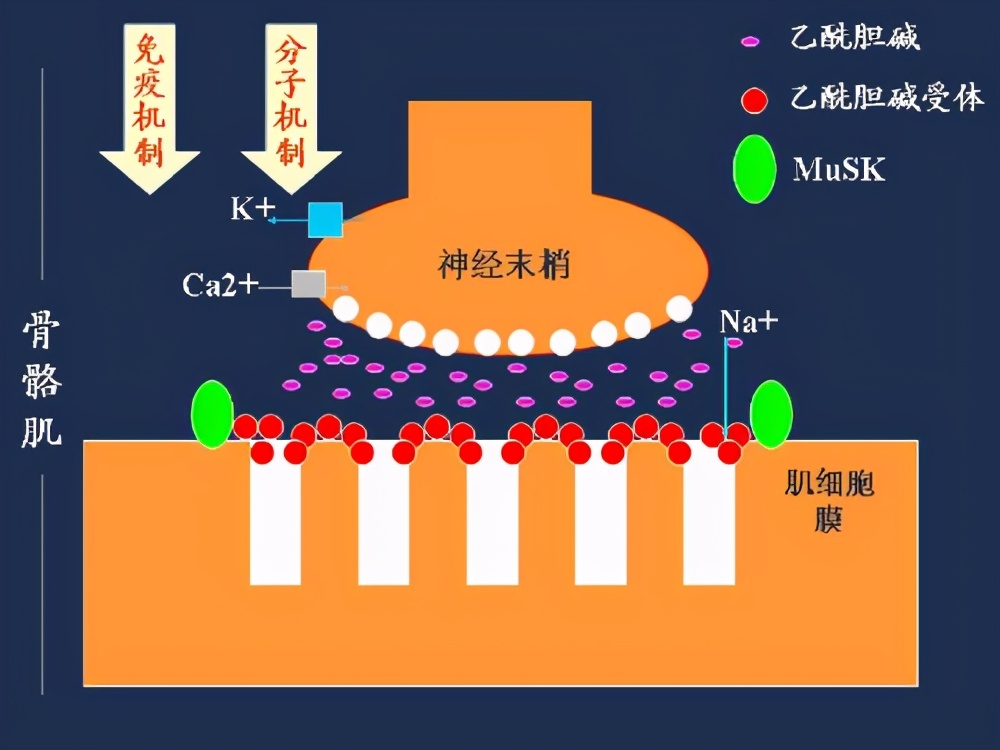 干燥综合征和重症肌无力,干燥综合征会不会出现焦虑抑郁