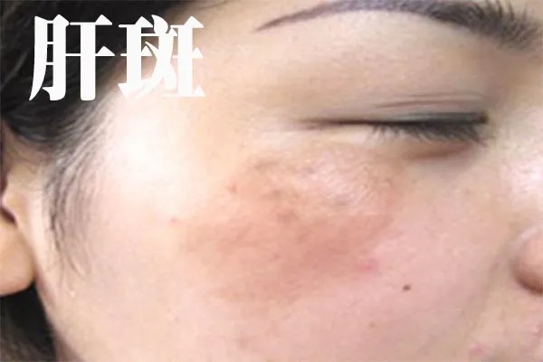 欧阳医生带你了解*褐斑黄**的成因及预防