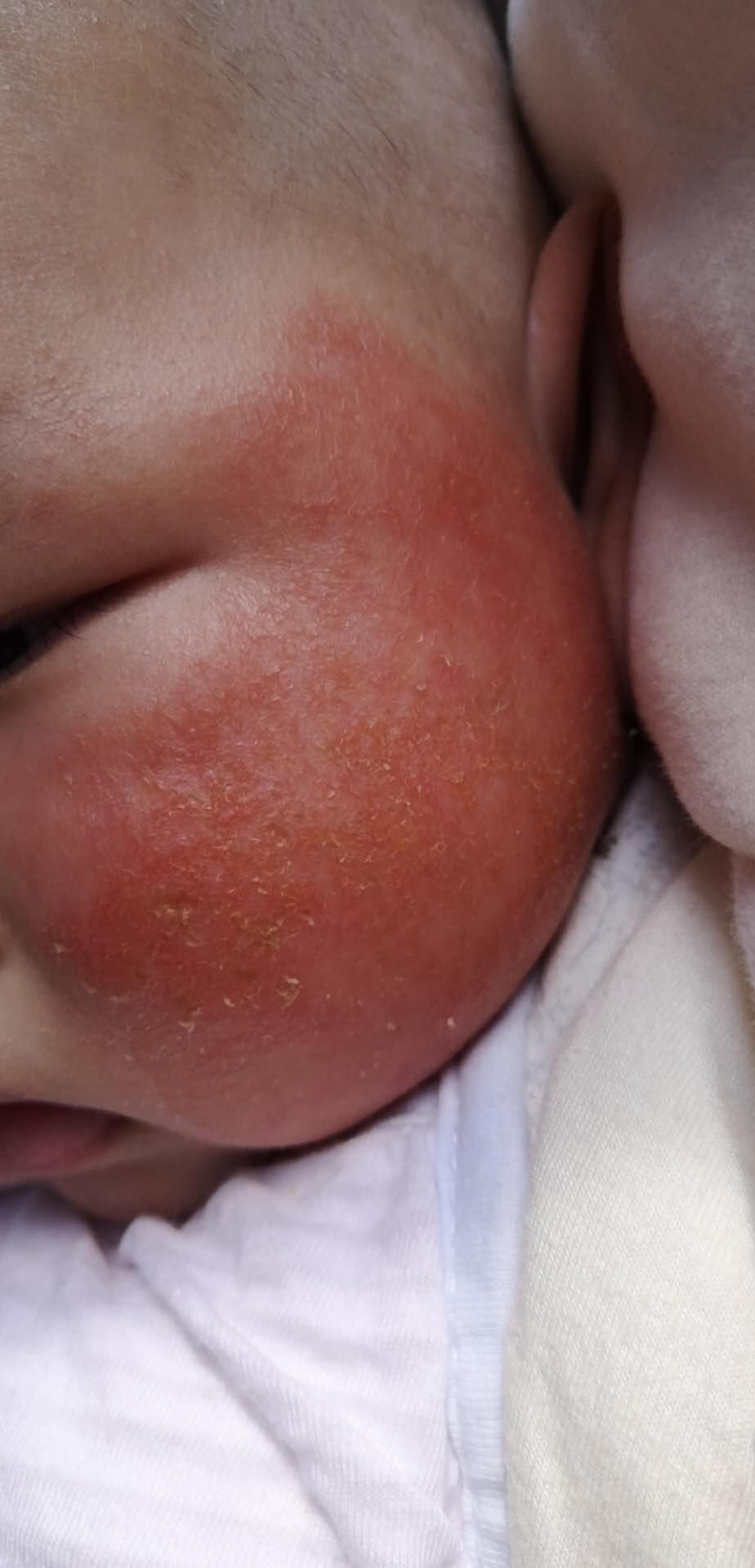 湿疹疾病的发病特征有哪些,新生儿湿疹判断