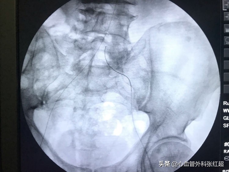 外周血管外科治疗范围,外周血管介入治疗疗程