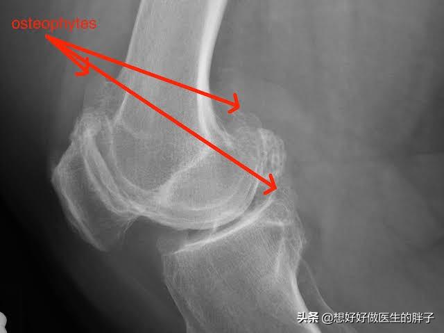 膝盖怎样知道有骨刺,膝盖有骨刺中医怎么治