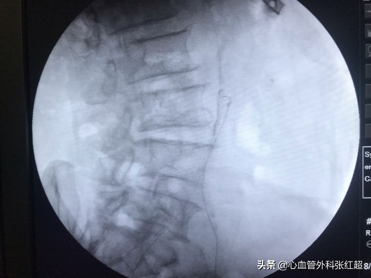 外周血管外科治疗范围,外周血管介入治疗疗程