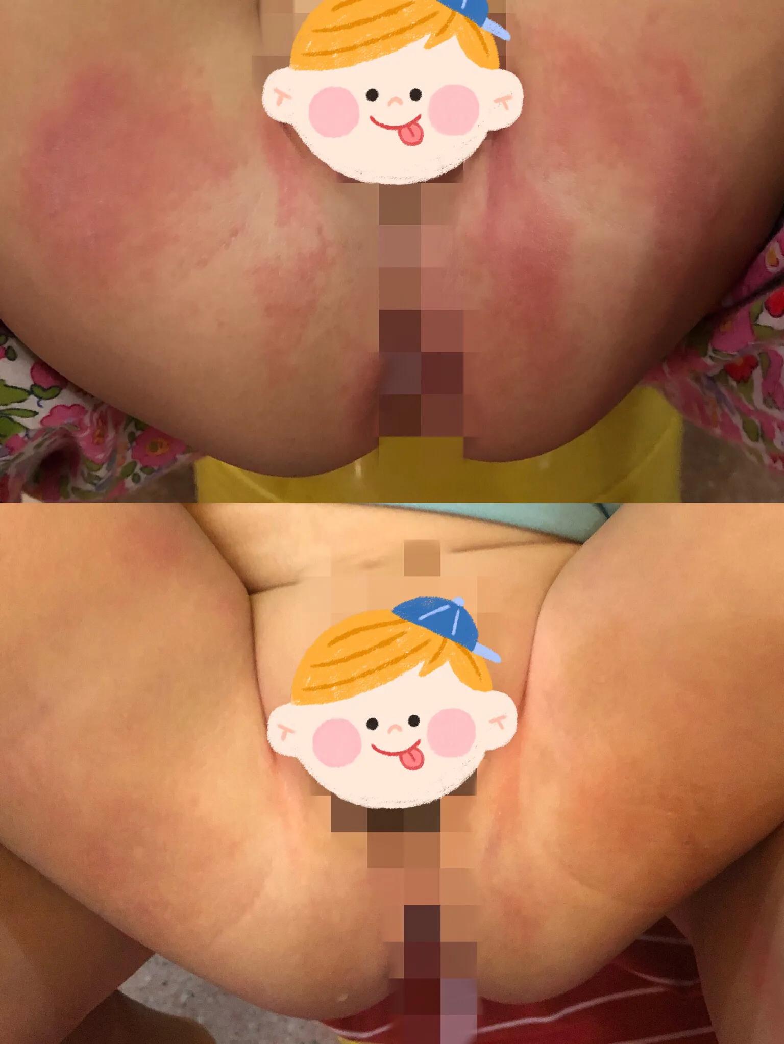 宝宝尿布皮炎什么样,尿布皮炎如何处理