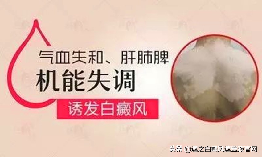 中医解密：如何调理脏腑让白癜风治疗变得简单