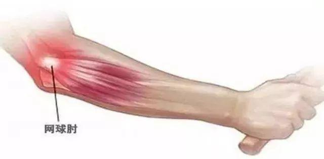 手肘忽然酸痛怎么缓解,手肘酸痛怎么办最快解决方法