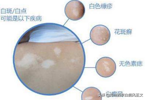 小儿白癜风高发怎么办,2岁儿童怎么确诊白癜风最准确