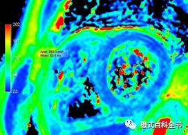 心脏磁共振定位方法,心脏磁共振各参数分析