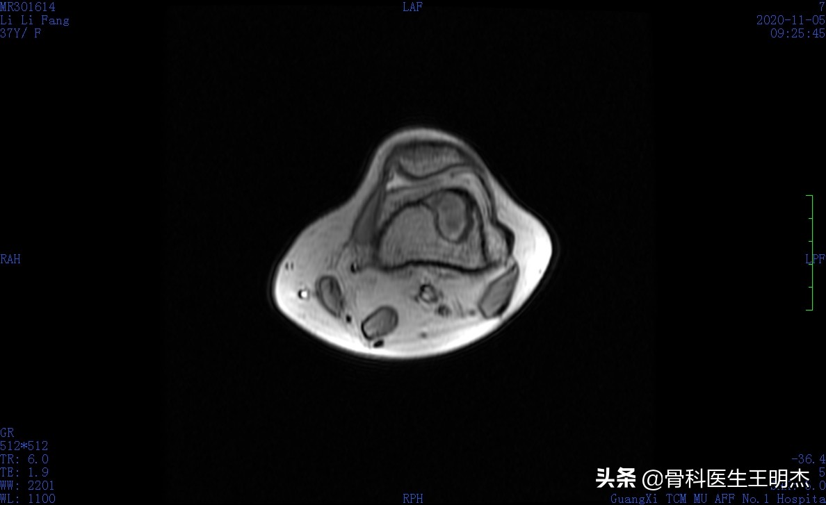 骨梗死是骨癌吗,骨梗死的治疗