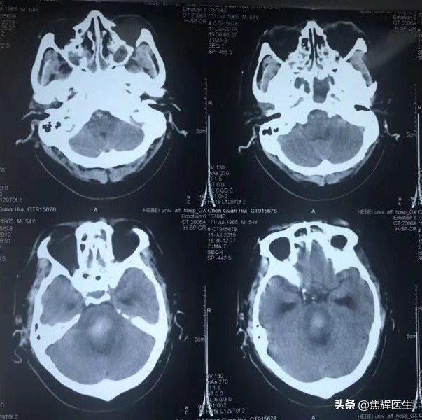 脑干出血最好的自己锻炼方法,怎么快速让脑干出血康复治愈