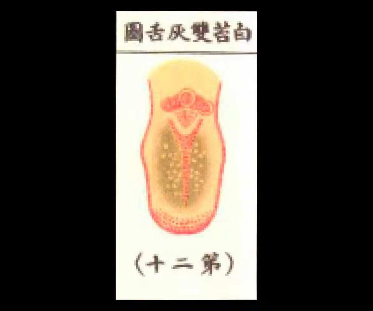 白苔厚腻有湿热的可能吗,舌根和舌中有黄腻苔中医辨证