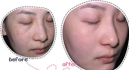 明星超皮秒祛斑,明星皮秒祛斑完整视频