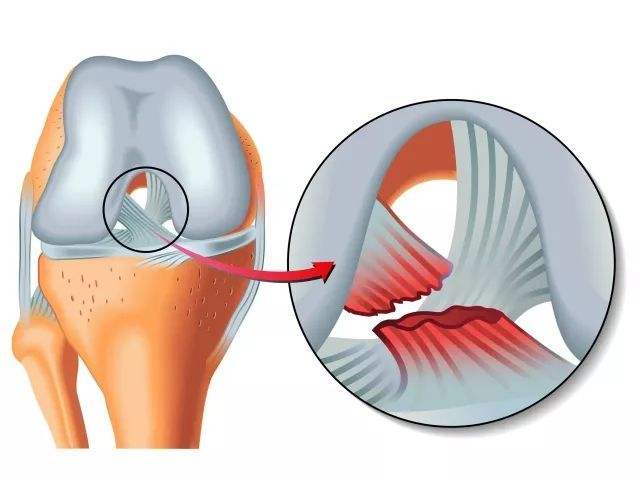 膝前叉韧带损伤严重还是变性严重,膝关节前叉韧带断裂膝盖会松动吗