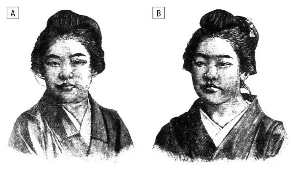 双眼皮真的有那么漂亮吗,自然双眼皮和割的双眼皮内在区别