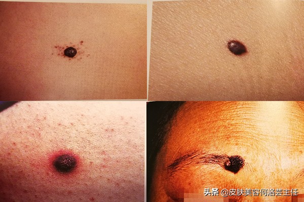 为什么色素痣会越来越多,有无色素痣都要注意什么