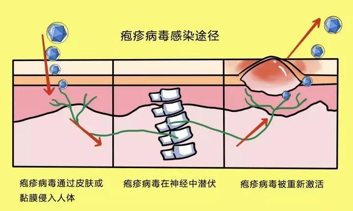 口唇疱疹好了上嘴唇又起泡结黄痂,嘴角疱疹和上火长泡的区别
