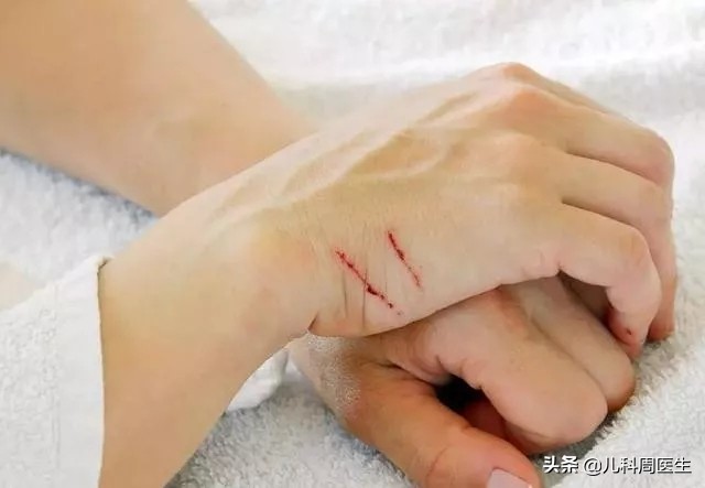 被小猫挠伤需要打疫苗吗,被猫挠了出血了需要打疫苗吗