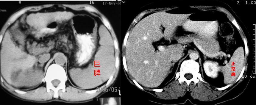 引起脾亢的原因,脾亢一定要切除吗