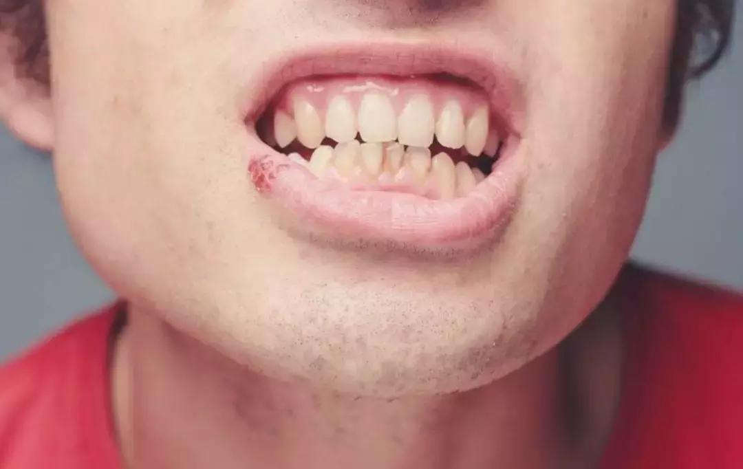 下身长疱疹怎么办,手上长疱疹怎么办