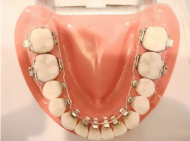 牙齿为什么会黑三角,牙齿出现黑三角是为什么