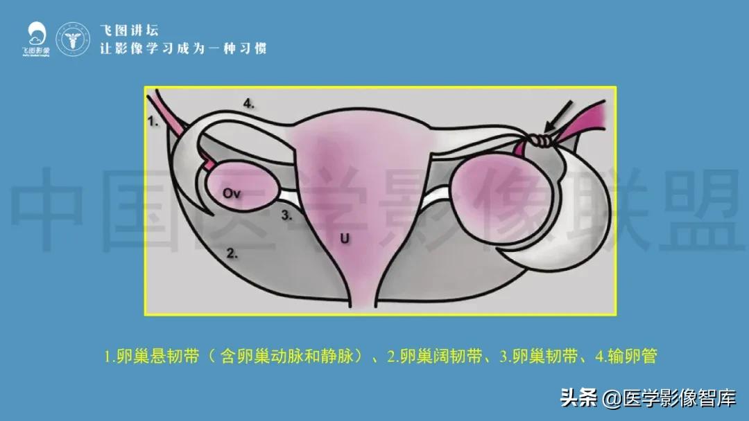 子宫解剖结构输卵管和卵巢位置,子宫附件ct影像学正常解剖表现