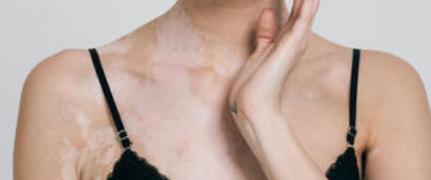 小孩被查出疑似白癜风,8岁孩子被确诊白癜风