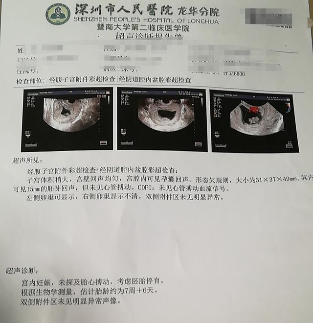 稽留流产超声表现,稽留流产什么意思