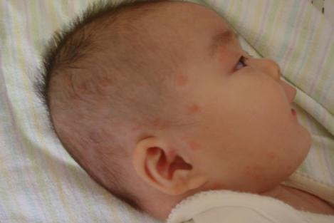 手部湿疹一招搞定,儿童湿疹总是反复教你一招搞定它