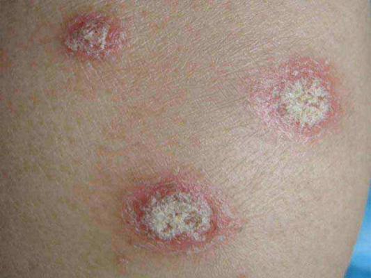 银屑病真的是无法治愈吗,银屑病到底有没有治愈的案例