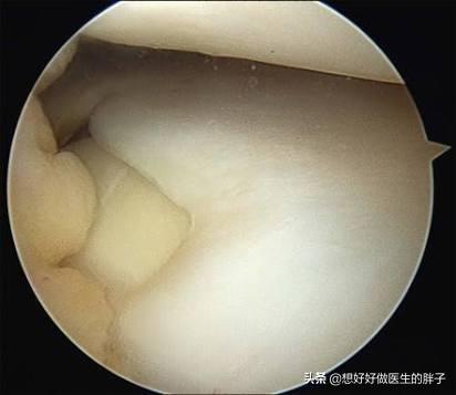 走走路膝盖就软一下怎么回事,走路时一条腿软摔倒怎么回事