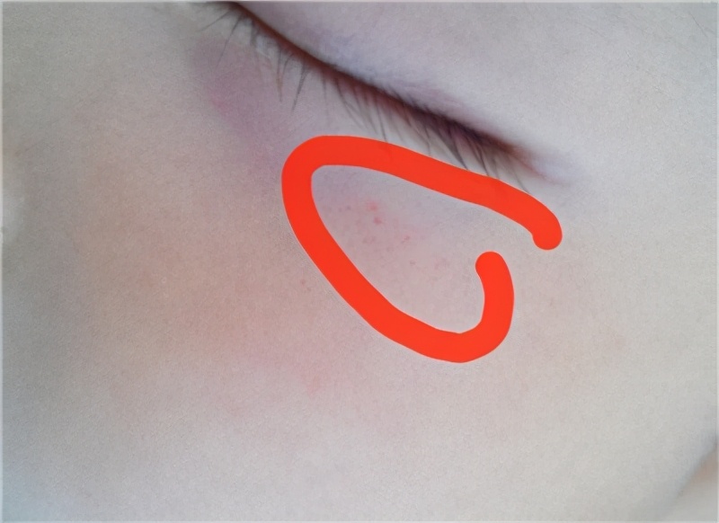 为什么小孩嘴唇周围会出现紫癜,儿童眼周围出现很多小血点紫癜图