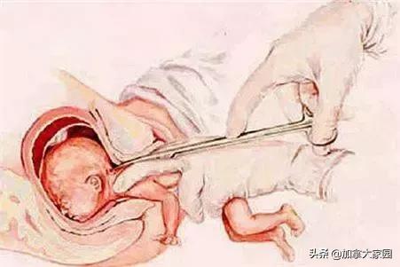 女性避孕贴片新型,美国避孕贴效果怎么样