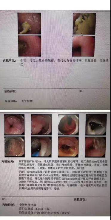 *安泰**市中心医院完成市首例弥漫性食管痉挛合并贲门失弛缓肌切开术