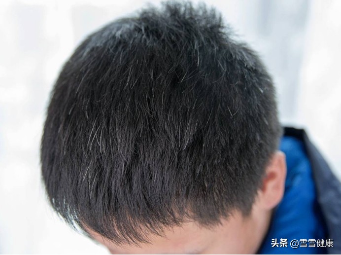 少年白是身体不行了吗,少年白有什么方法改善