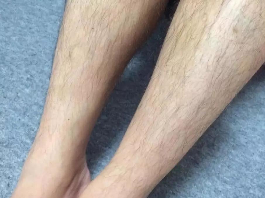 米诺地尔有什么副作用吗,米诺地尔副作用和禁忌