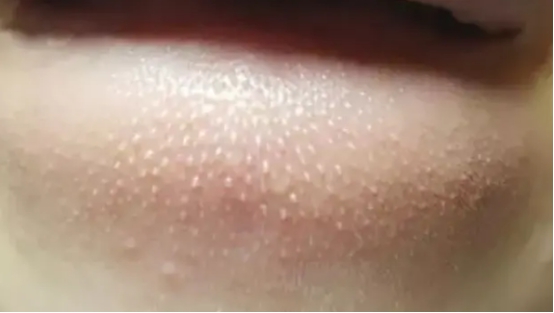 脸上小米粒疙瘩是什么问题,脸上长了白色的小米粒图片