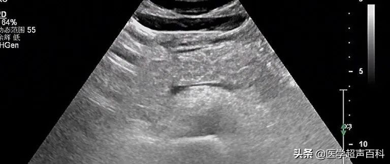 急性胰腺炎超声表现,犬急性胰腺炎超声