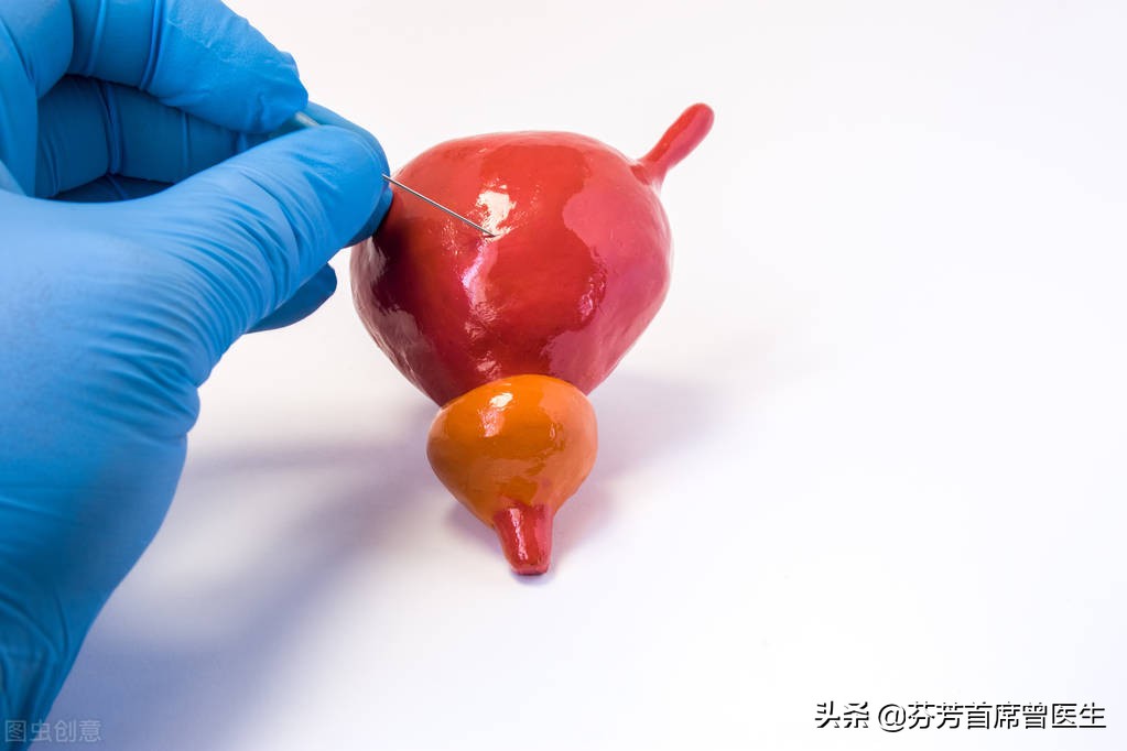 膀胱癌患者大部分存活不过20年,一个已存活15年的晚期膀胱癌患者