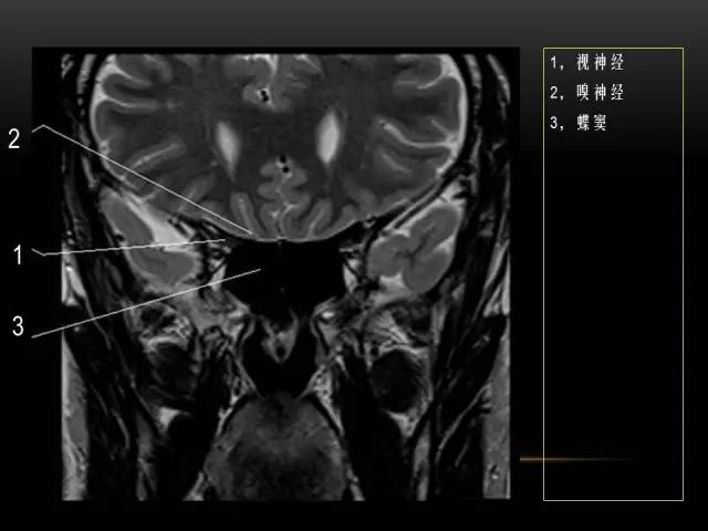 鼻腔鼻窦及颅底ct影像解剖,鼻窦解剖mri